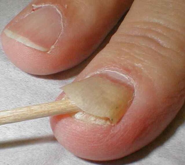peeling the nail with toenail fungus