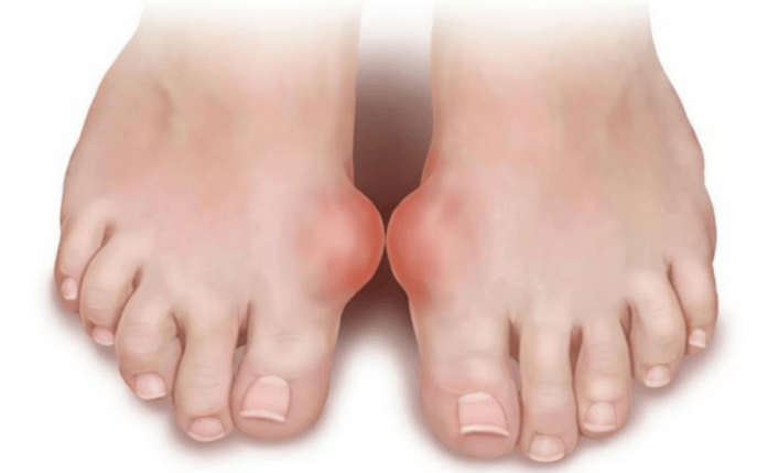 foot deformity as a cause of the appearance of fungus on the foot