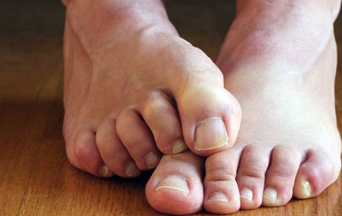 symptoms of squamous fungus on foot