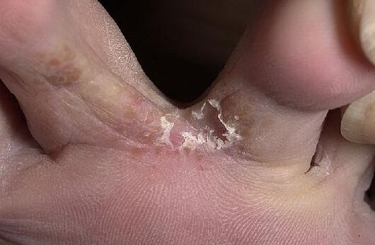 toes affected by the fungus