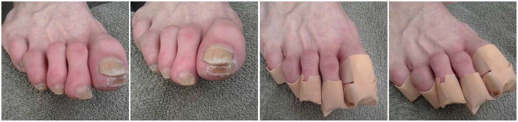 Apply patches for toenail fungus
