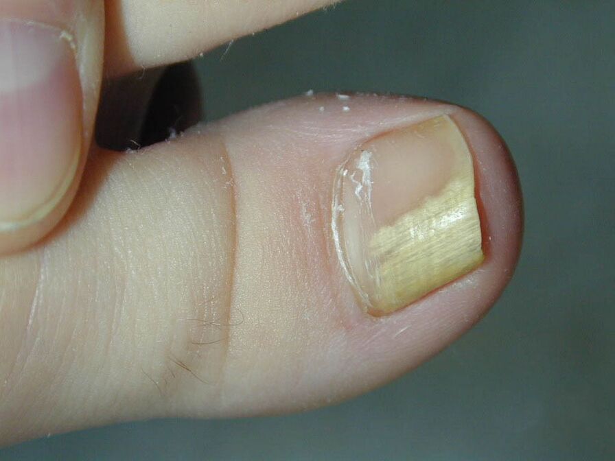 Symptoms of fungus - nail stain