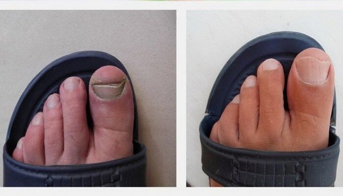 toenails before and after treatment of fungi with apple cider vinegar