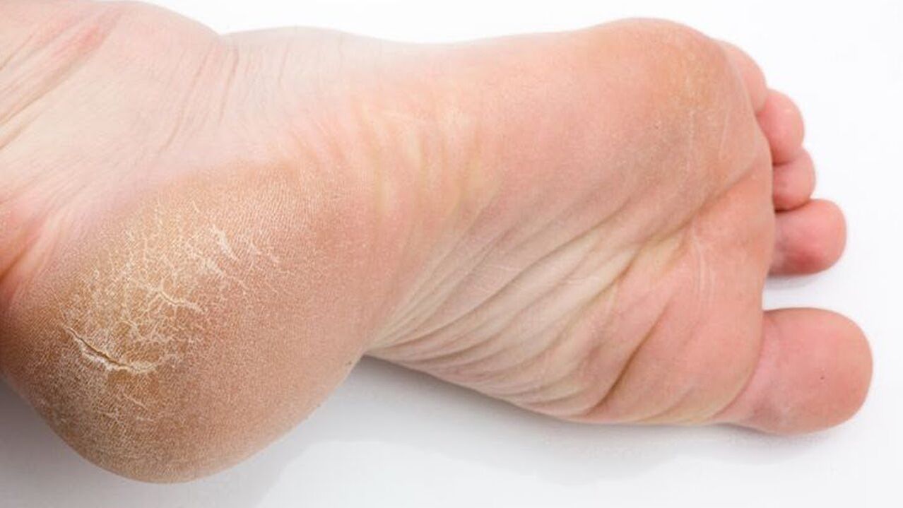 fungus on the skin of the feet