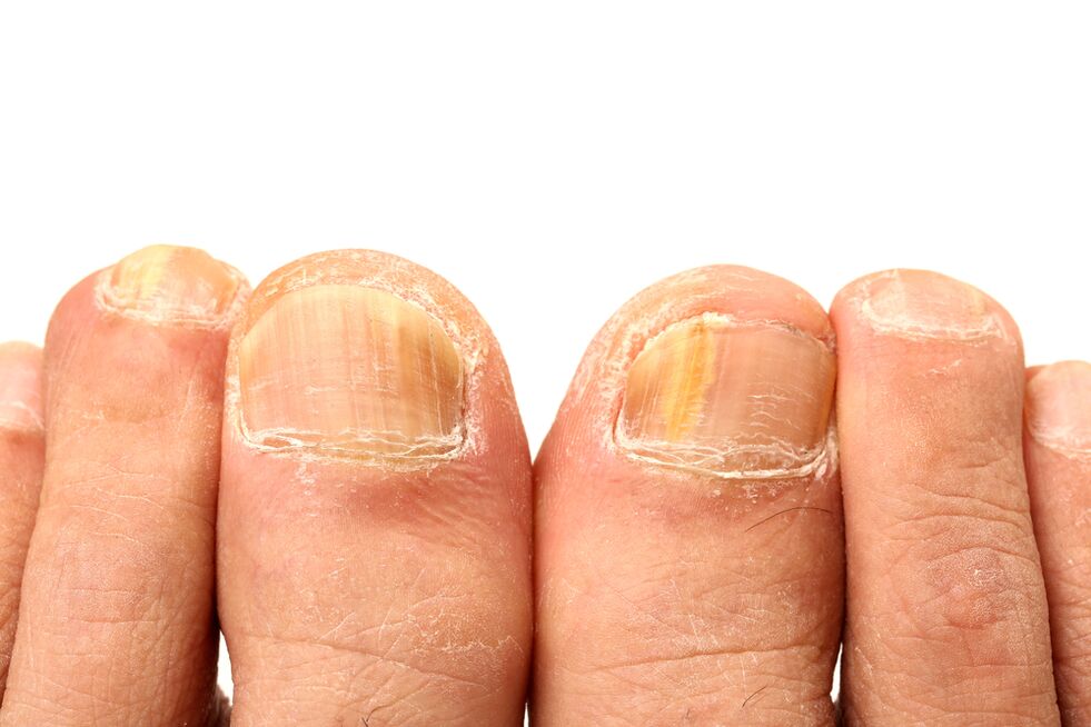 what do nail fungus look like