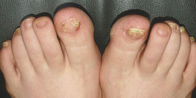 The onycomycosis of the nails in the legs