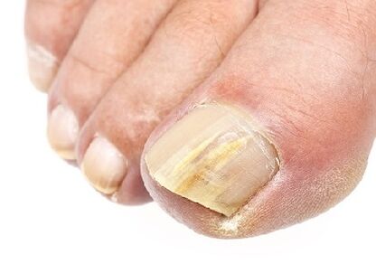 What looks like nail fungus