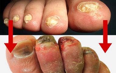 Fungus manifestations on the fingers