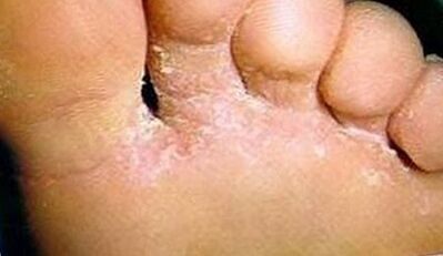 How to know the fungus on the fingers
