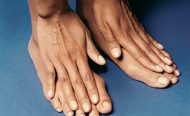 How to treat a fungus on your fingers