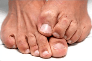 itchy feet due to a fungal nail infection