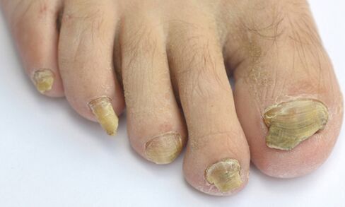 Causes and symptoms of toenail fungus