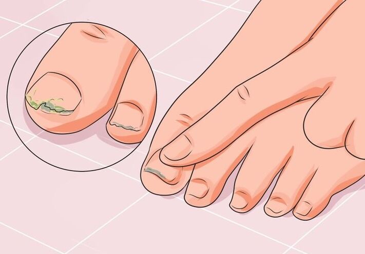 How to treat toenail fungus