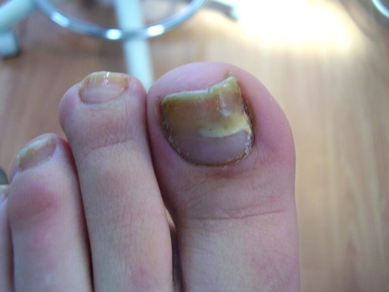 How to treat yellow nails due to spot fungus