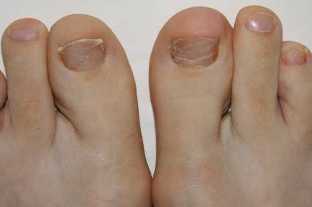 The symptoms of foot fungus