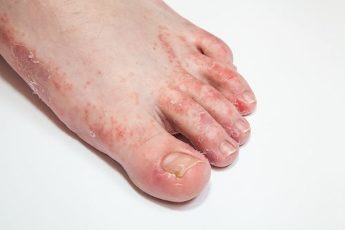 foot fungus and nail Polish